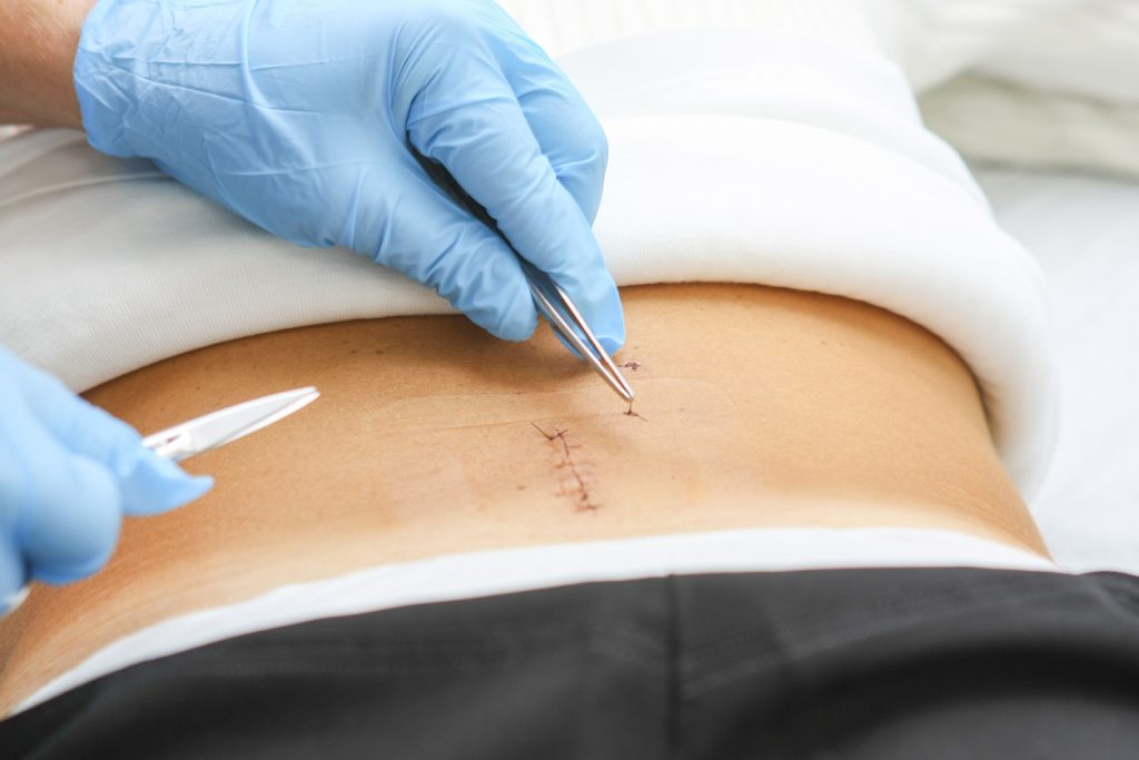 Minimally Invasive Spine Surgery